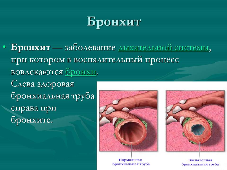 Бронхит