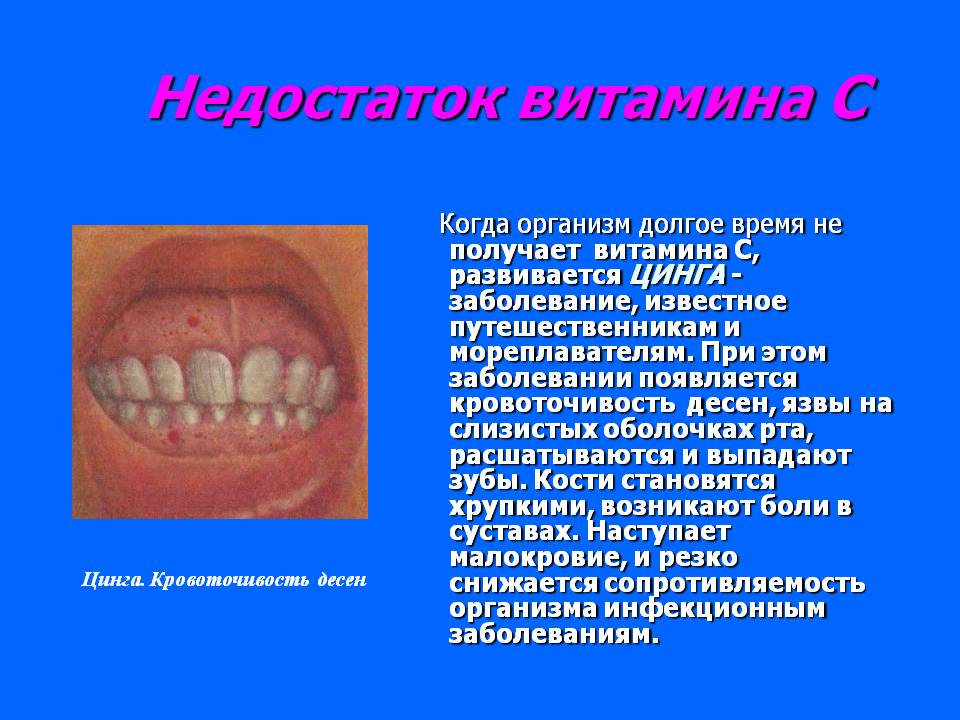 Недостаток витамина С