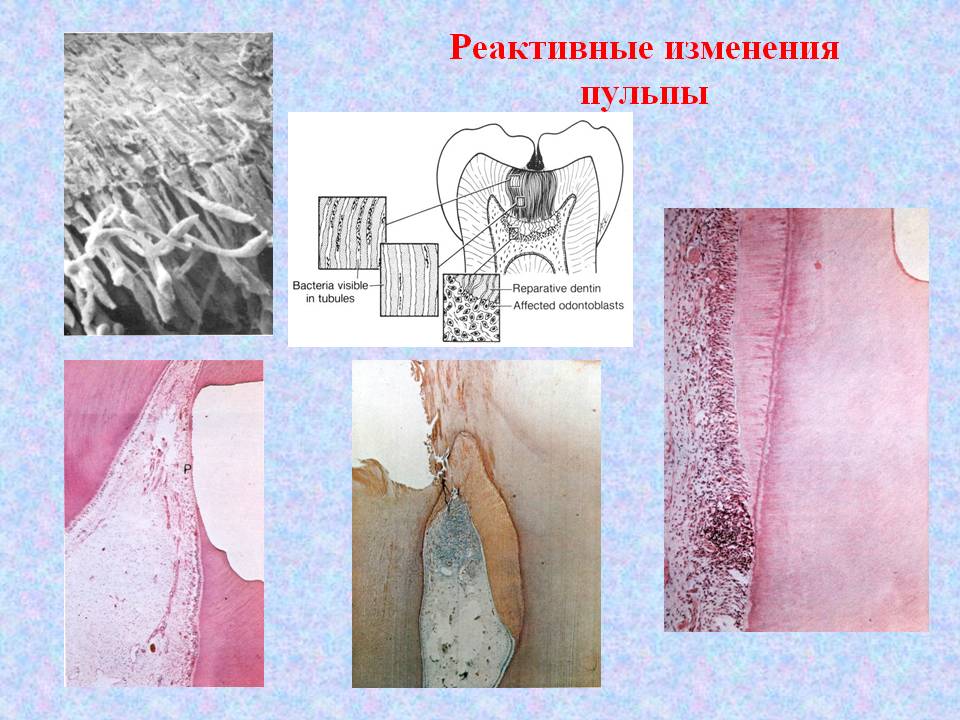 Реактивные изменения пульпы