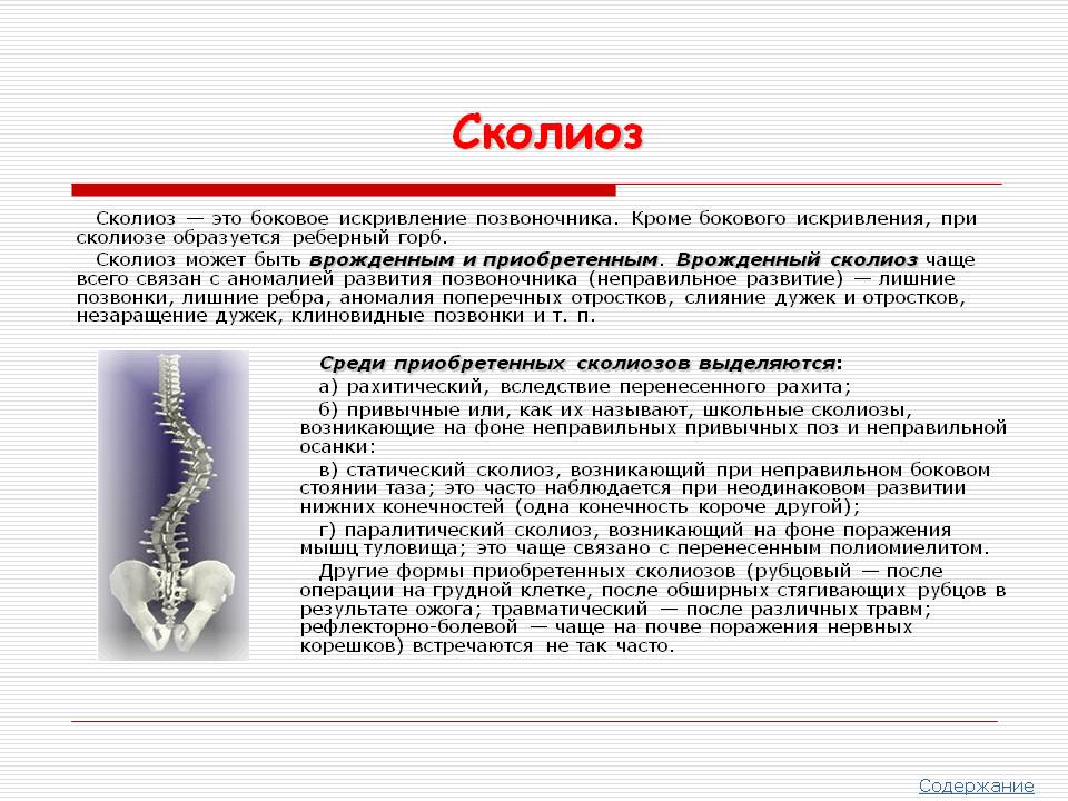 Сколиоз