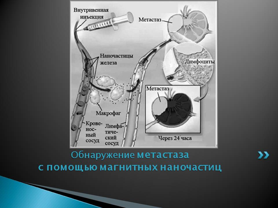 Обнаружение метастаза