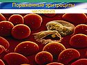 Поражённые эритроциты человека