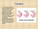 Гастрит